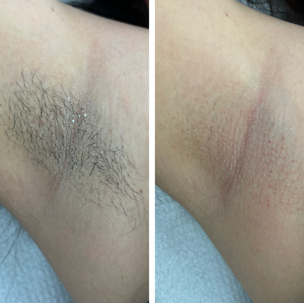 Underarm Wax