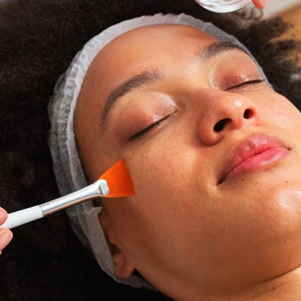 Chemical Peel at The Beauty Room in Dundee, FL