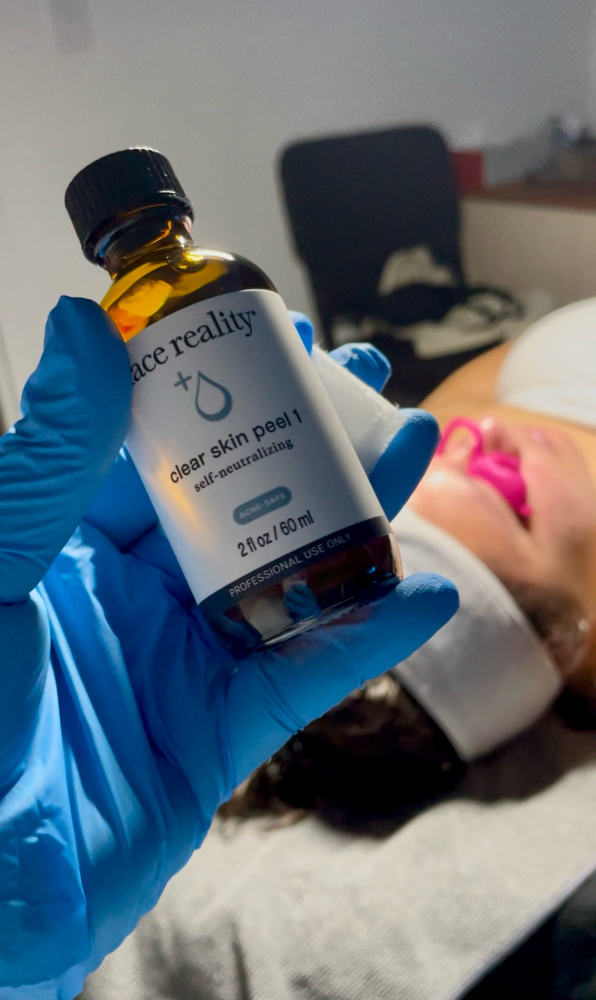 Supernova Chemical Peel