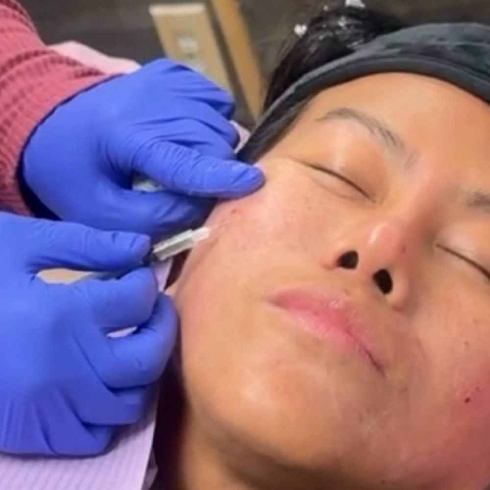 SkinStylus™ PRP/PRF Microneedling at Unmasked Aesthetics in Clackamas, OR