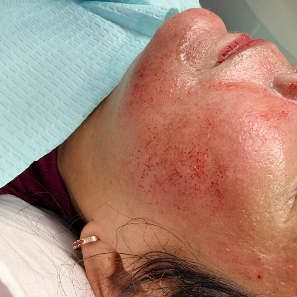 INTEGRITY© PRP/PRF Microneedling at Unmasked Aesthetics in Vancouver, WA