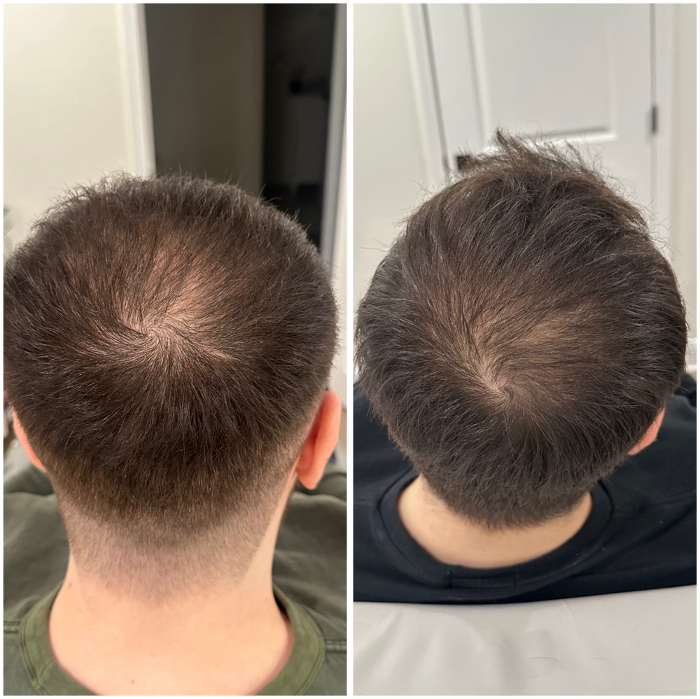 HAIR FOLLICULE STIMULATOR