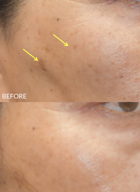 Mole & Sun-Spot Removal at Valoura Aesthetics in Houston, TX