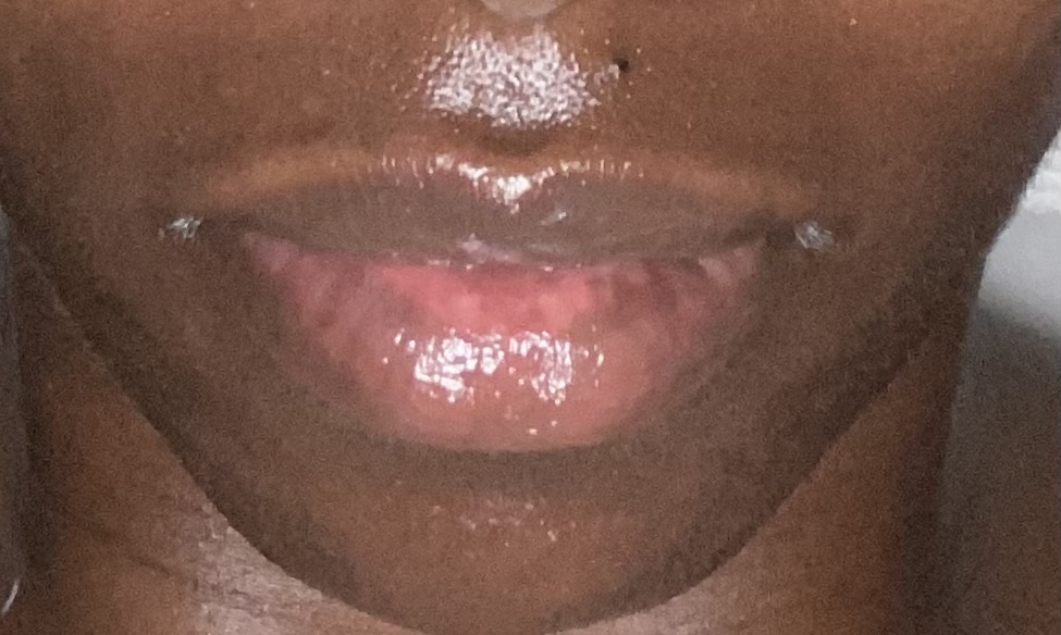 Lip Hair Removal