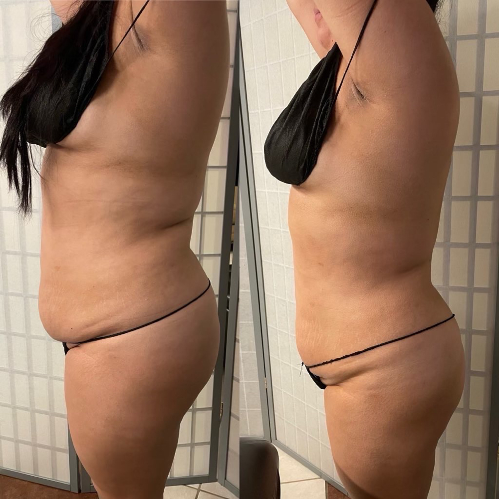 Body Contouring
