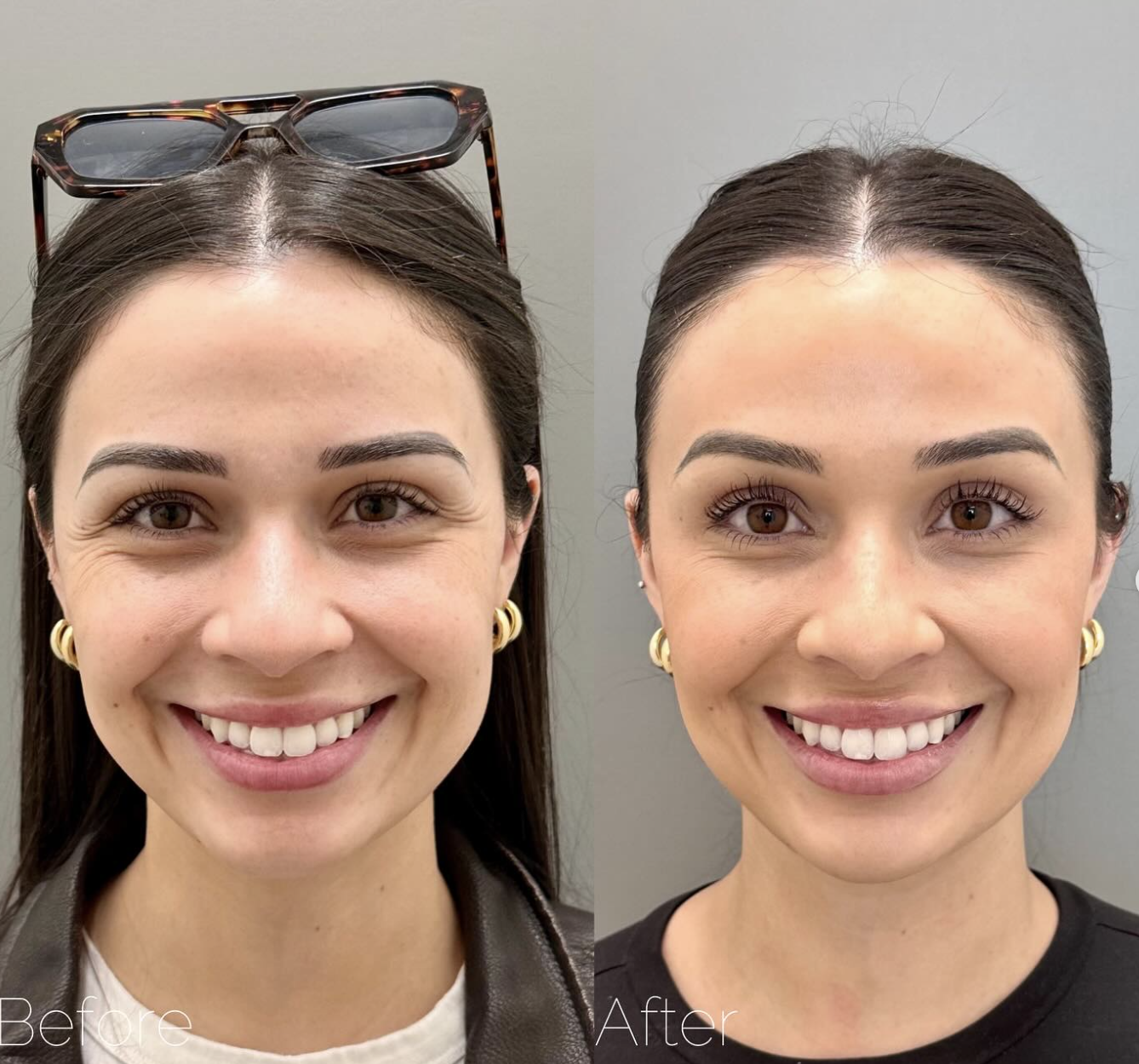 Eyebrow Lift