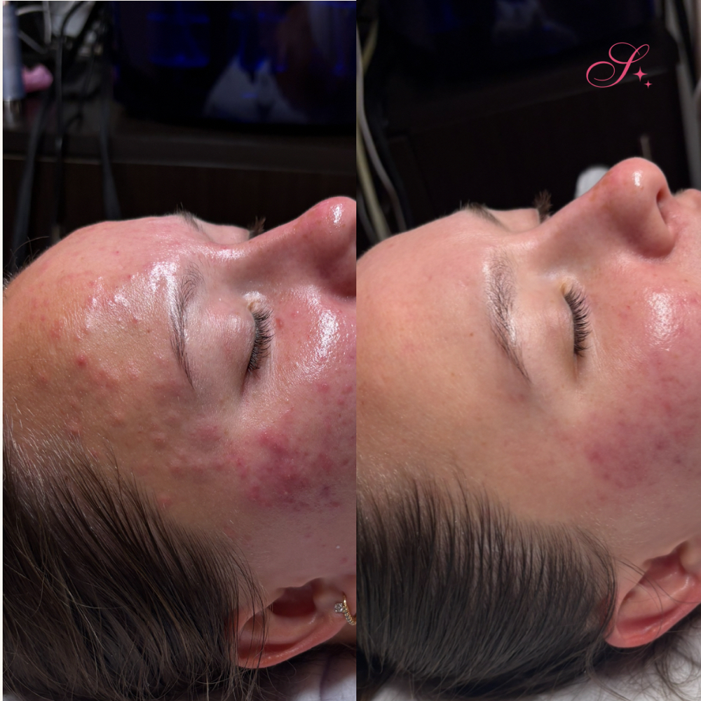 Acne Bootcamp 4 Week Treatment at The S Collective in altamonte springs, FL