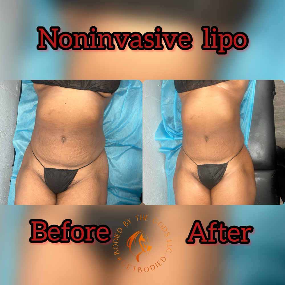 Non-Invasive Lipo