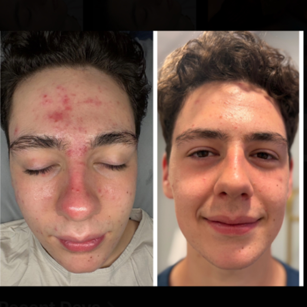 TEEN SKIN + ACNE FACIAL at Serenity By Sarina in Riverside, RI