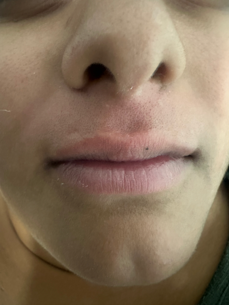 Lip (upper)