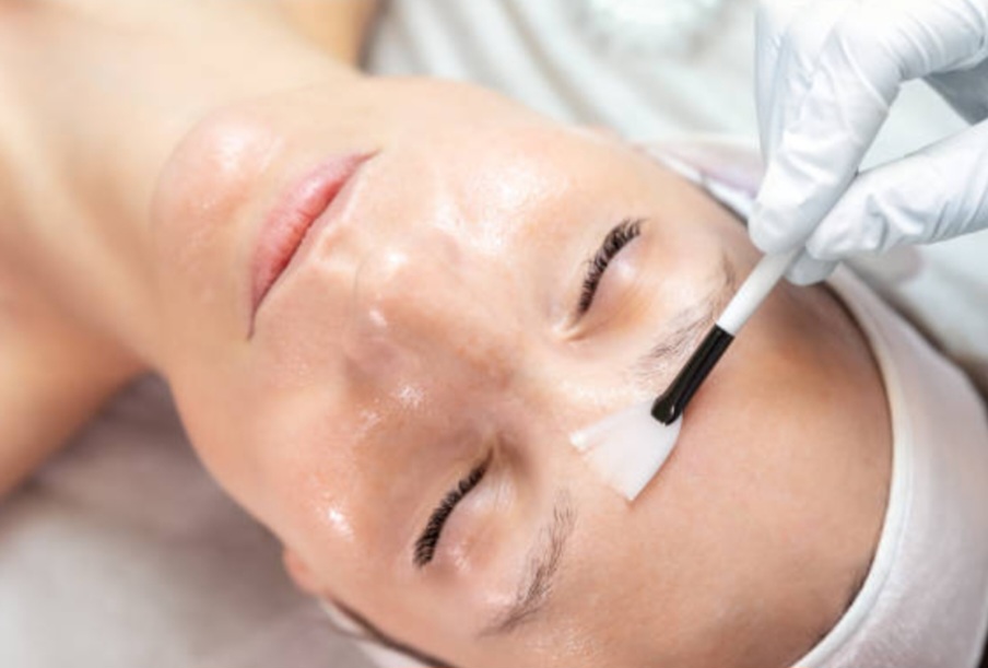 Chemical Peel (No Down Time)