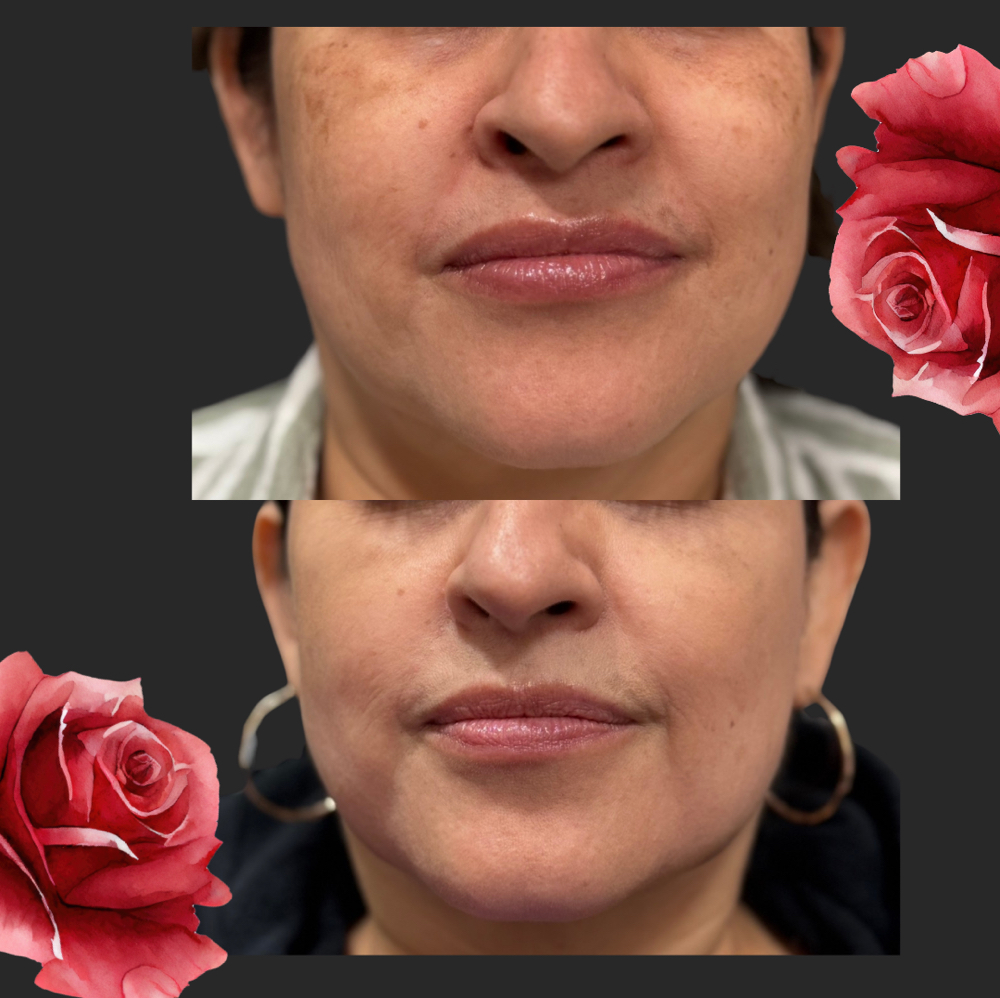 Microneedling with PRP at Forever Young Beauty RN in Rowlett, TX