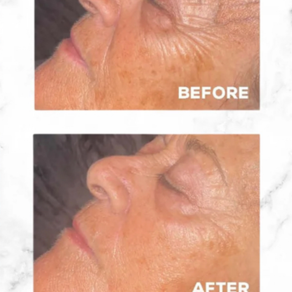 Nano Infusion With Topical Filler at The Beauty Room Salon & Spa in Lafayette, GA