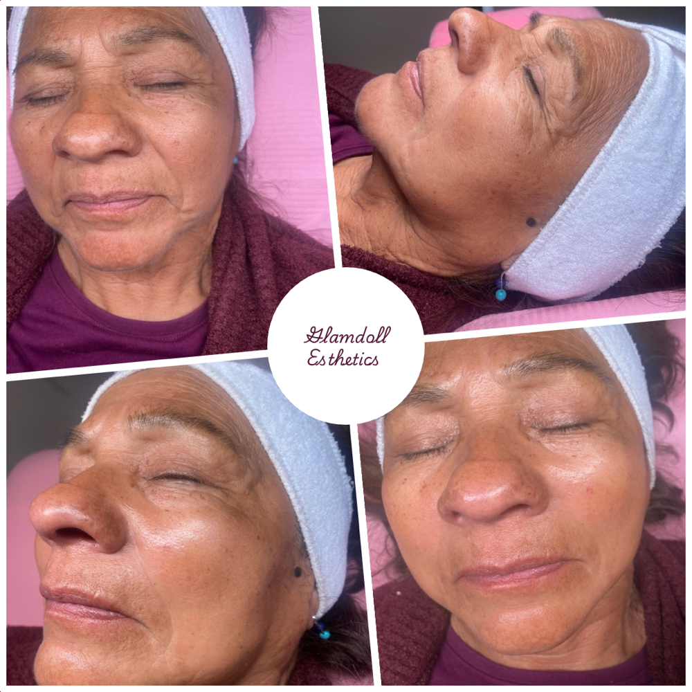 Microneedling Facial