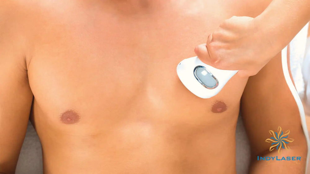 Areola Laser Hair Removal (single)