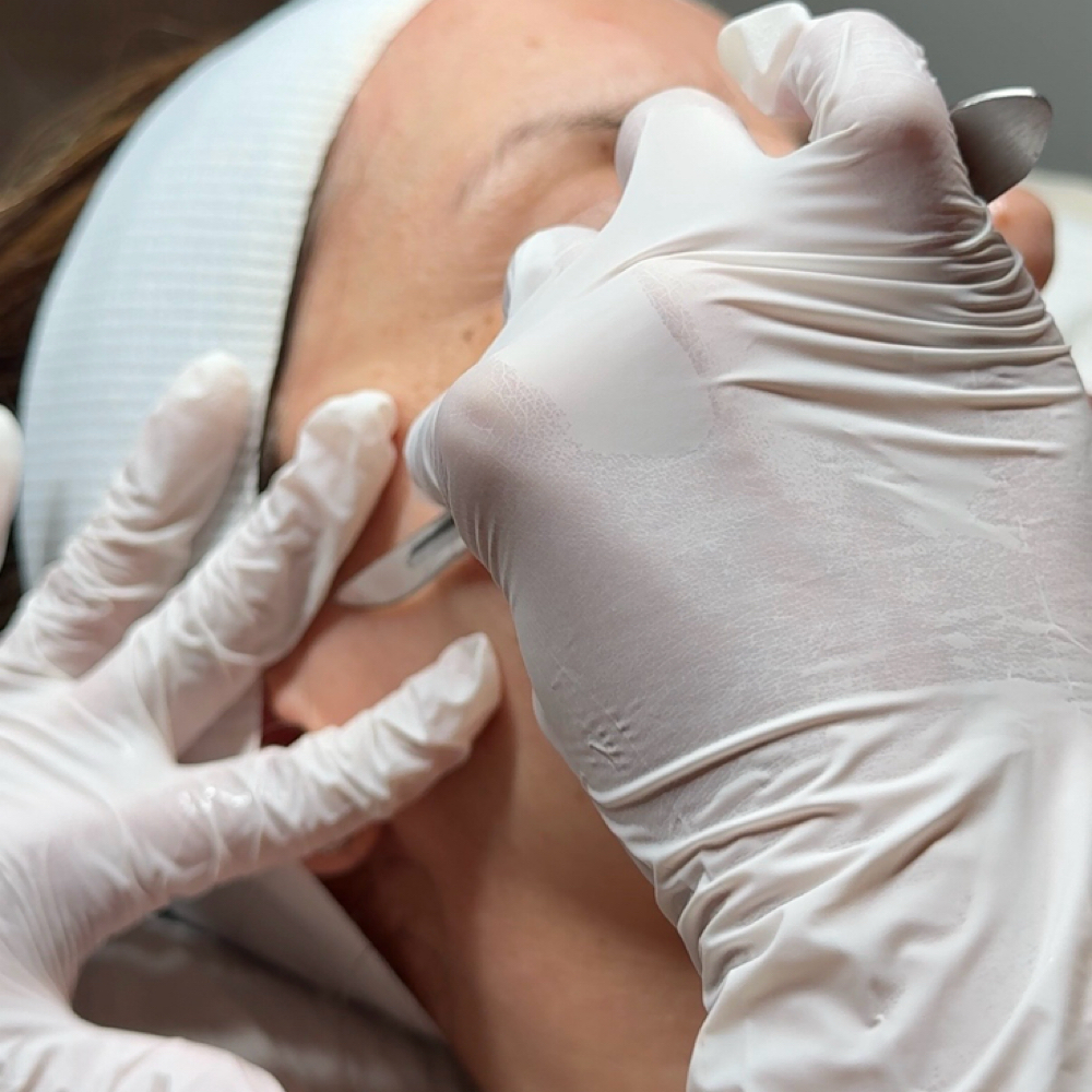 DERMAPLANING FACIAL at BYLISETTA in Vista, CA