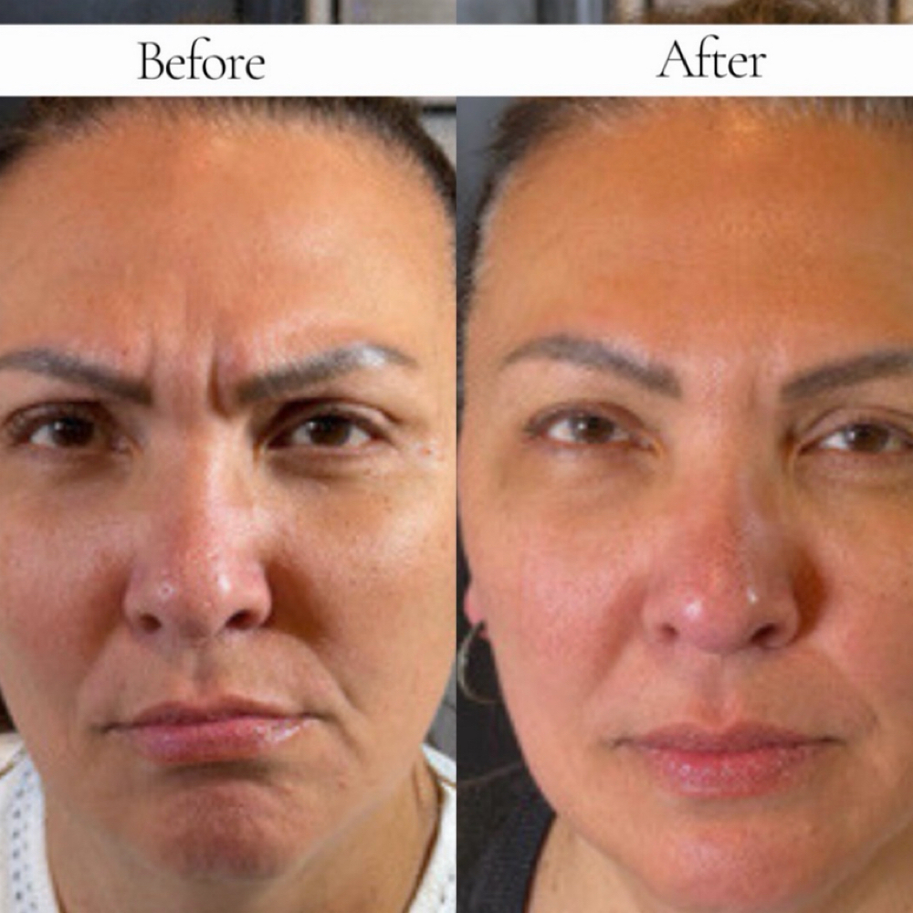 Daxxify Tox at Etch Aesthetics in rochester, NY