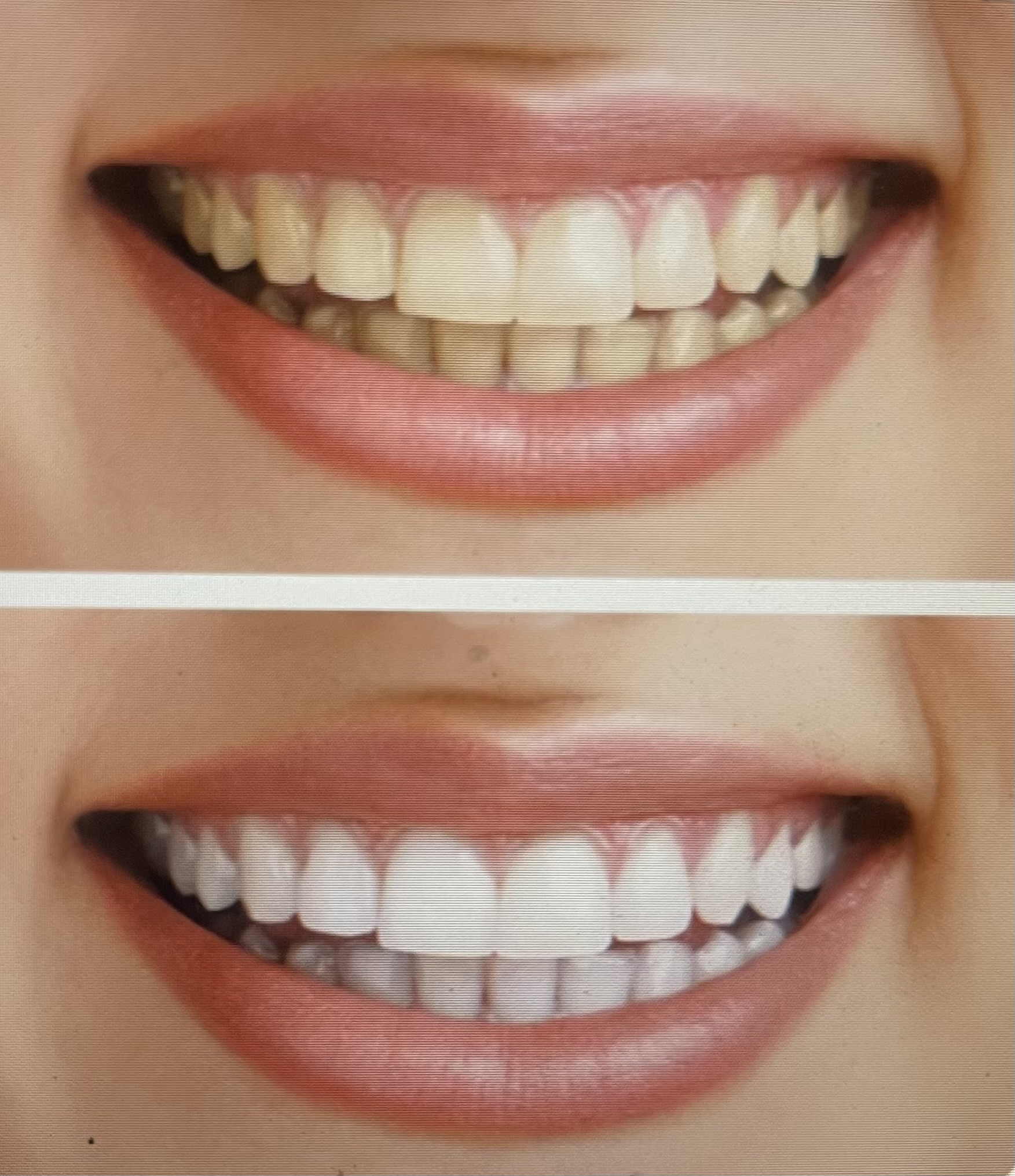 Teeth Whitening