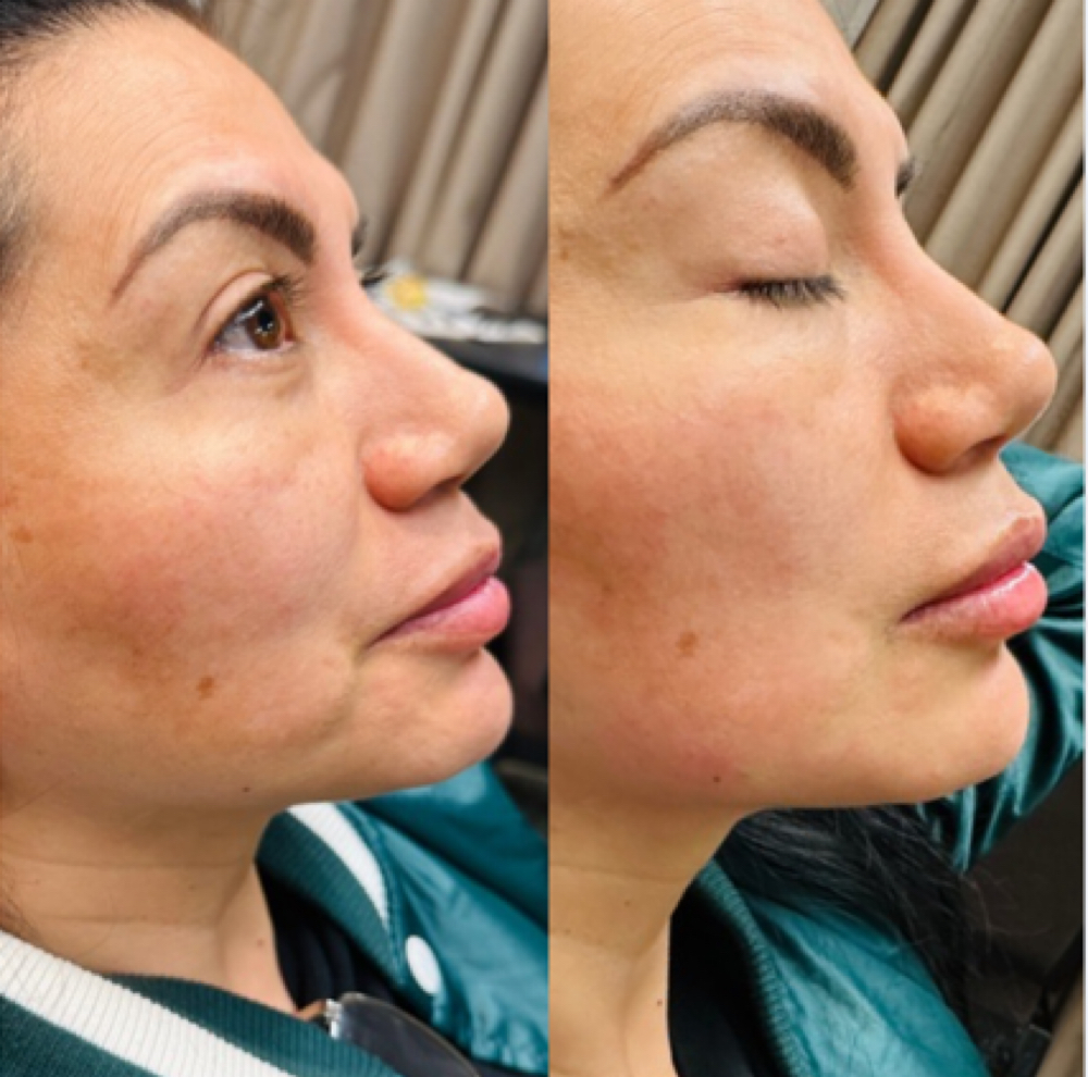 Chin Shadowing at Inject Me Pretty Aesthetic Studio in Round Rock, TX