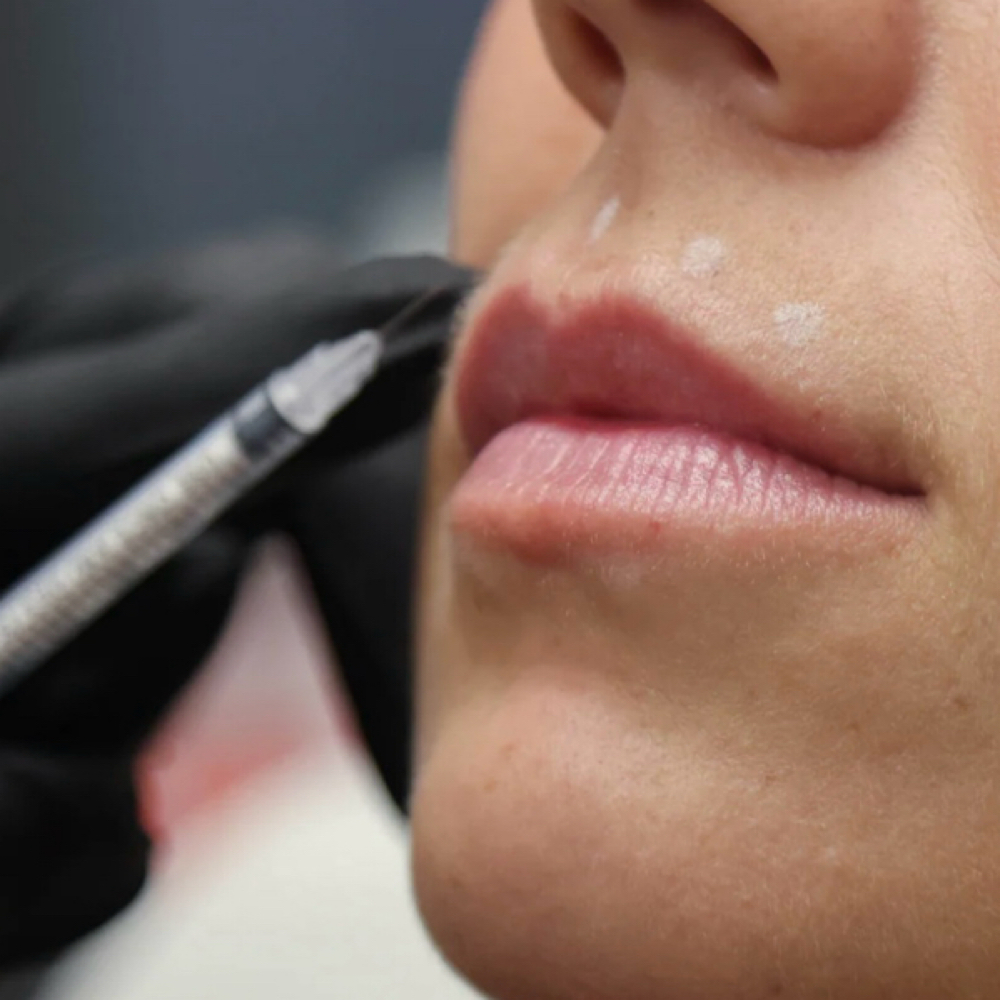 Lip Flip at Jay Michelle Aesthetics & Wellness in Lake Jackson, TX