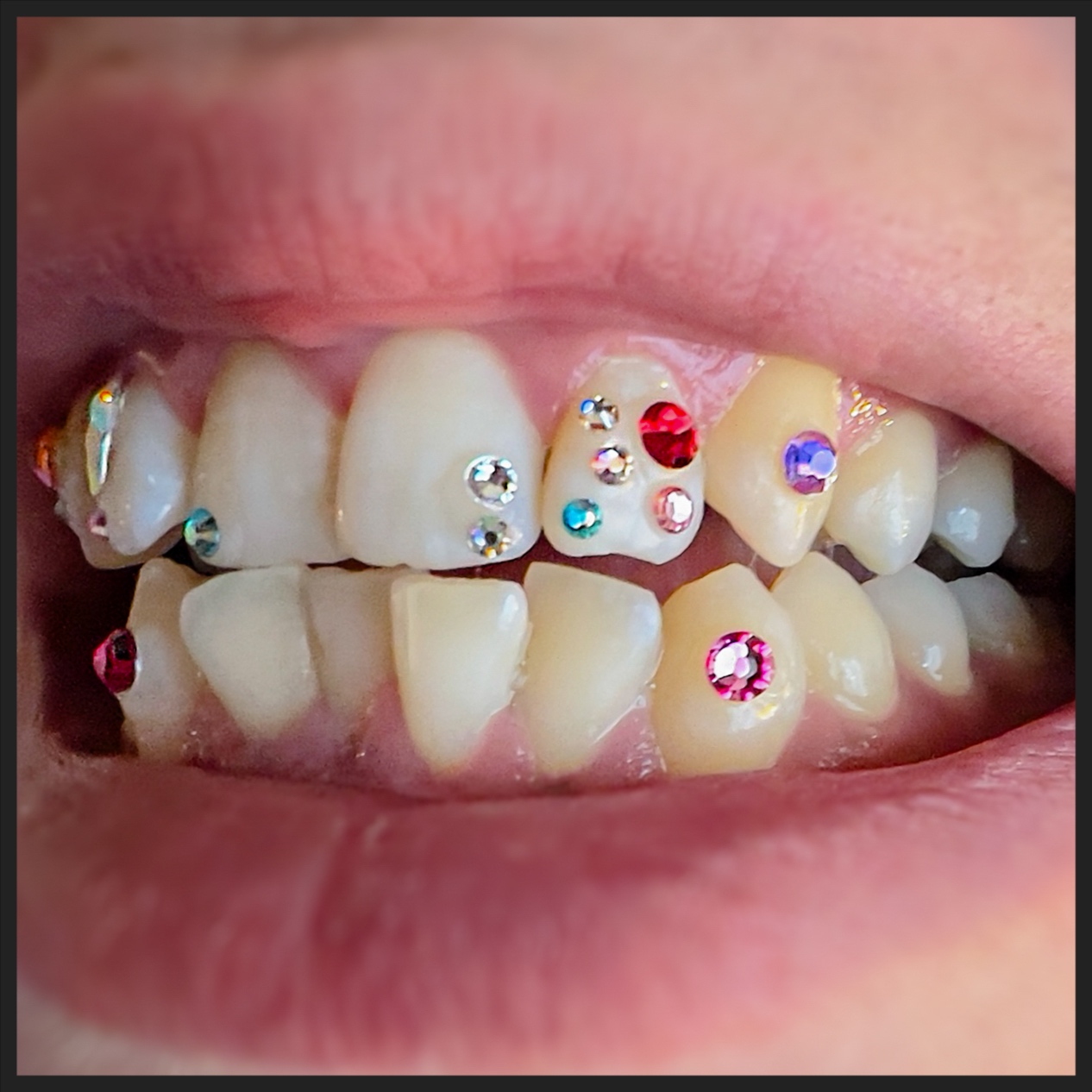 MEDIUM CLASSIC DESIGN at PsychoTeeth in manhattan, NY