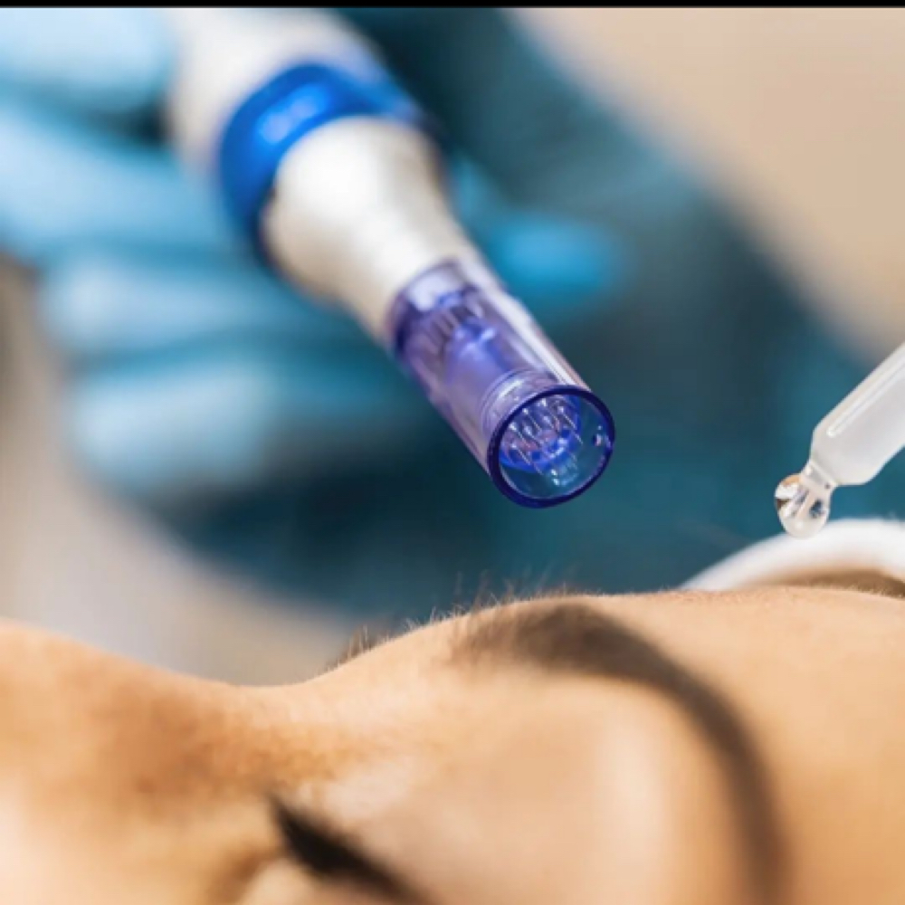 Hyaluronic Acid Microneedling Pkg/3 at Bare Esthetics Medical Spa LLC in Idabel, OK