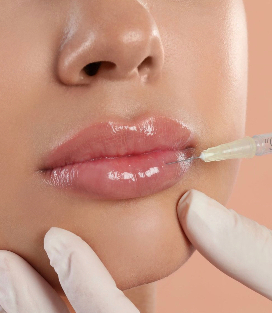 Versa Lips (filler)