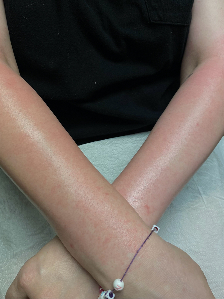 Full Arms at Bare Esthetics & Wellness in Greenville, NC