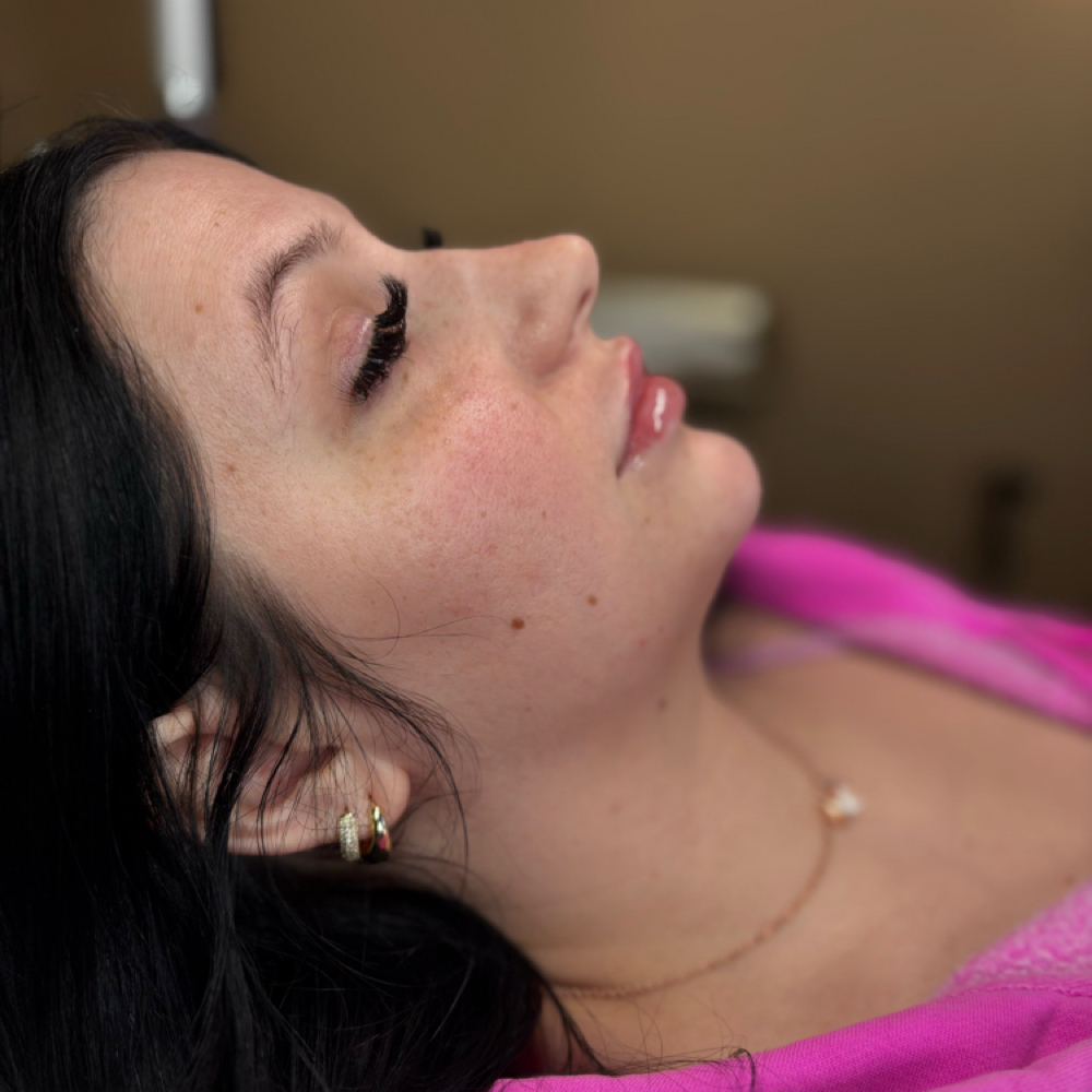 Chin Filler at Eluxy Aesthetics in Arlington, TX