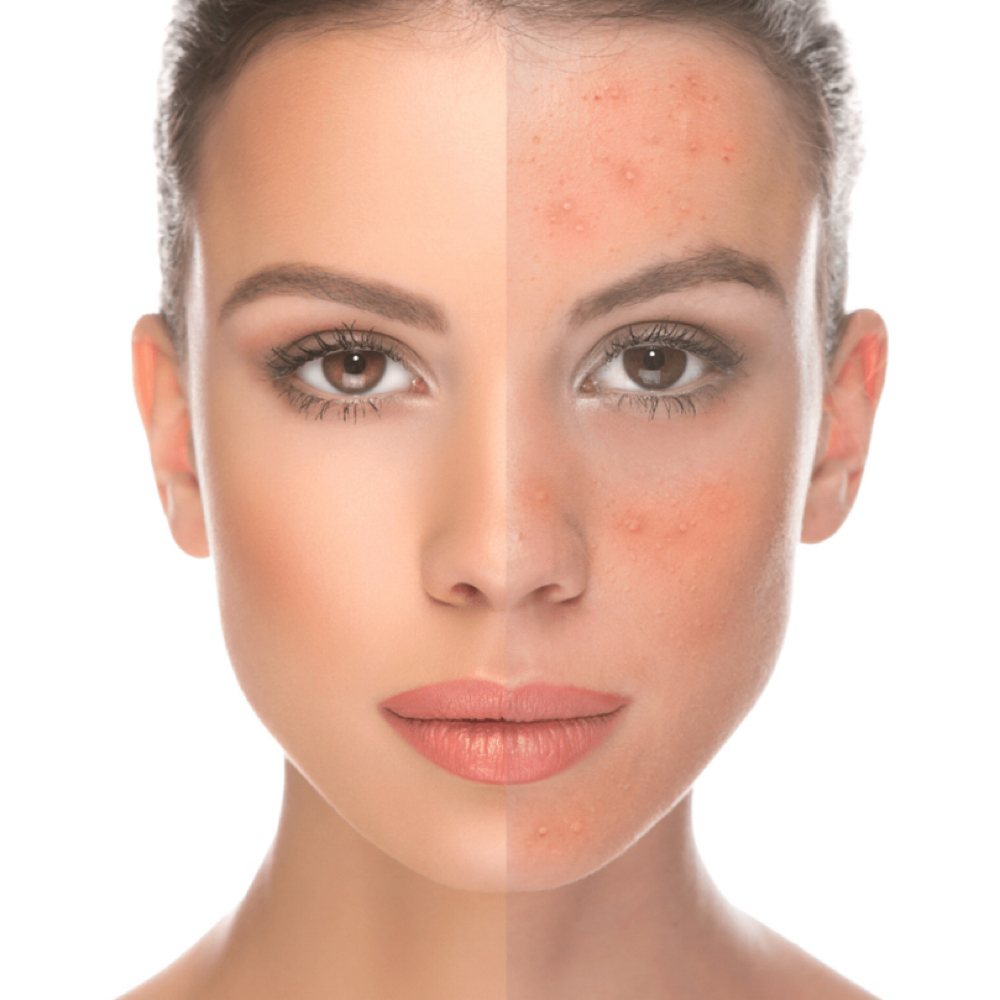 CHEMICAL PEEL at Beauty Lounge Prosper in McKinney, TX