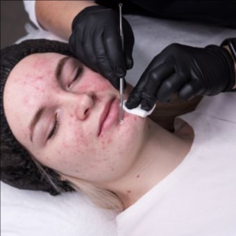 Acne Intervention Facial (Series) at Frilly Face Skincare Studio in Santa Cruz, CA