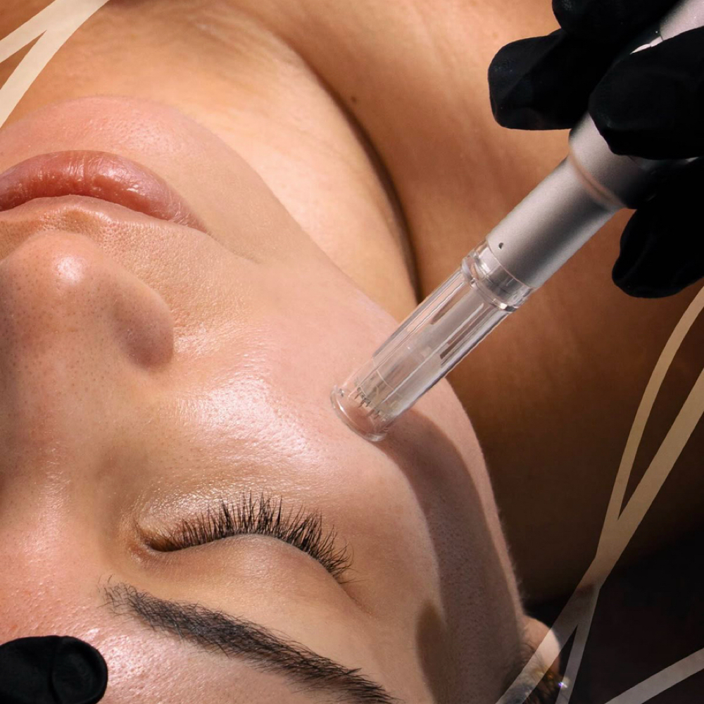 Microneedling Treatment at Glow Muse Studio in Arlington, TX