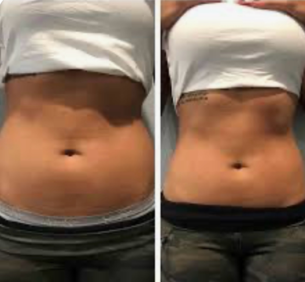 Cryoskin Abdomen Slimming