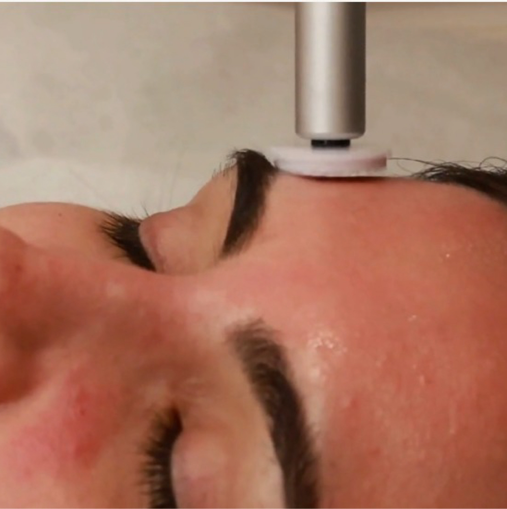 Microneedling + GlowExfo at GlowDerm Clinic in San Jose, CA