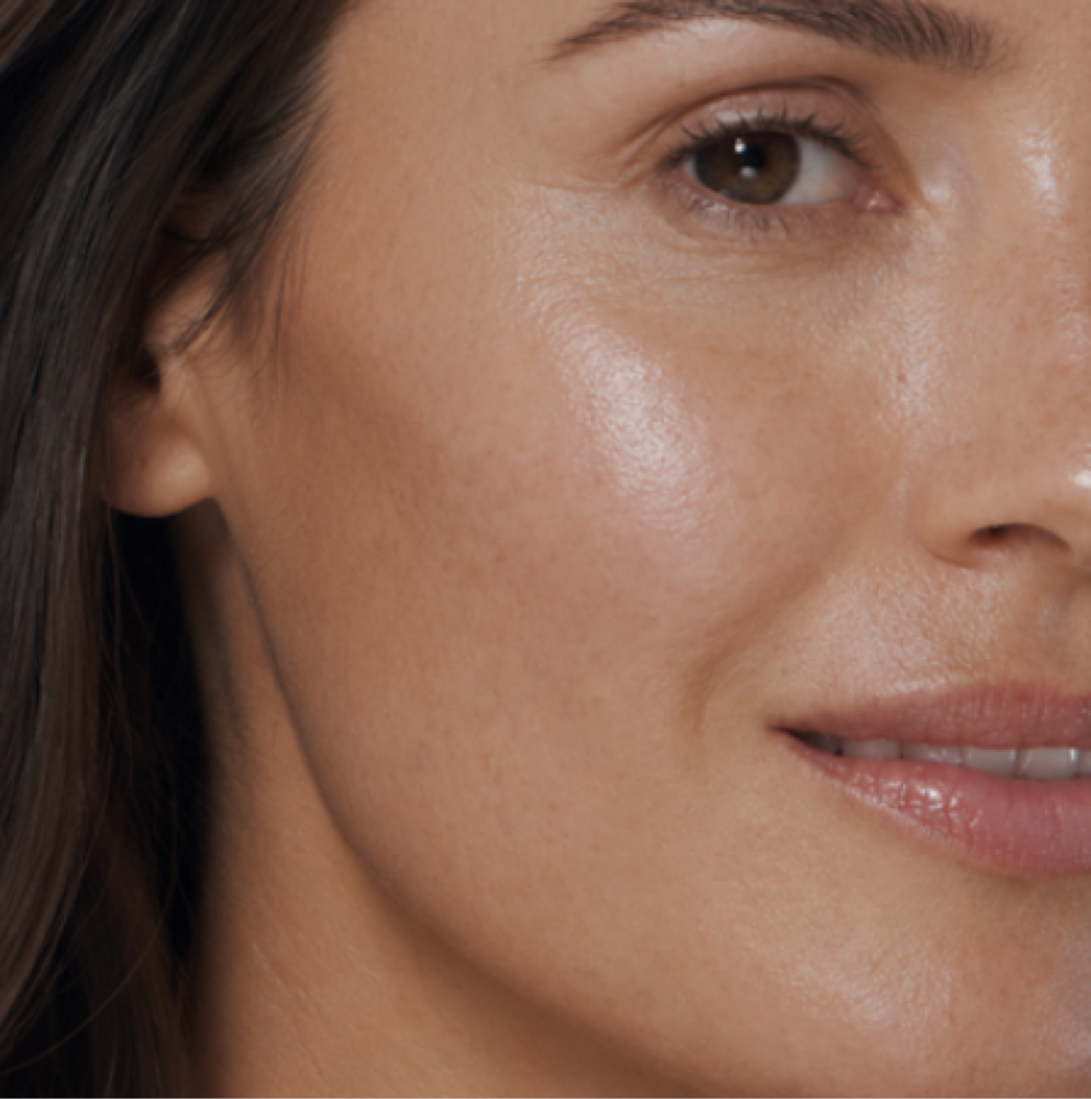 Microneedling at GlowDerm Clinic in San Jose, CA