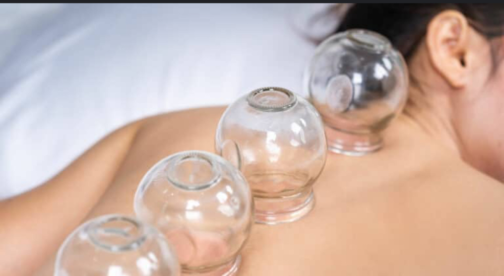 Cupping Therapy