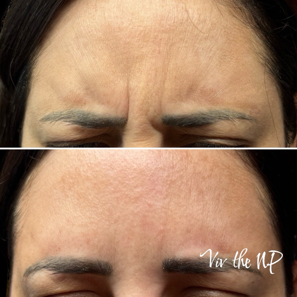 June Specials: Xeomin/Botox/Dysport