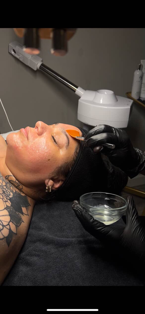 Chemical Peel (add on)