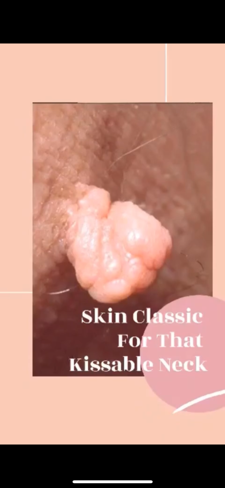 1 Skin Tags