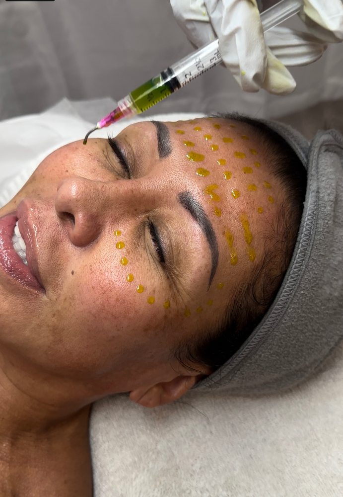 BioRePeel With Microneedling