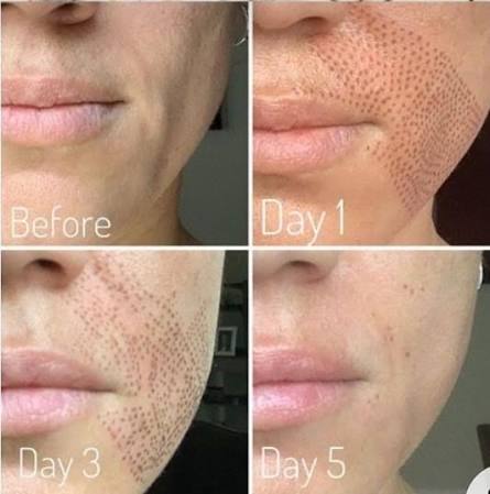 Fibroblast Smile Lines