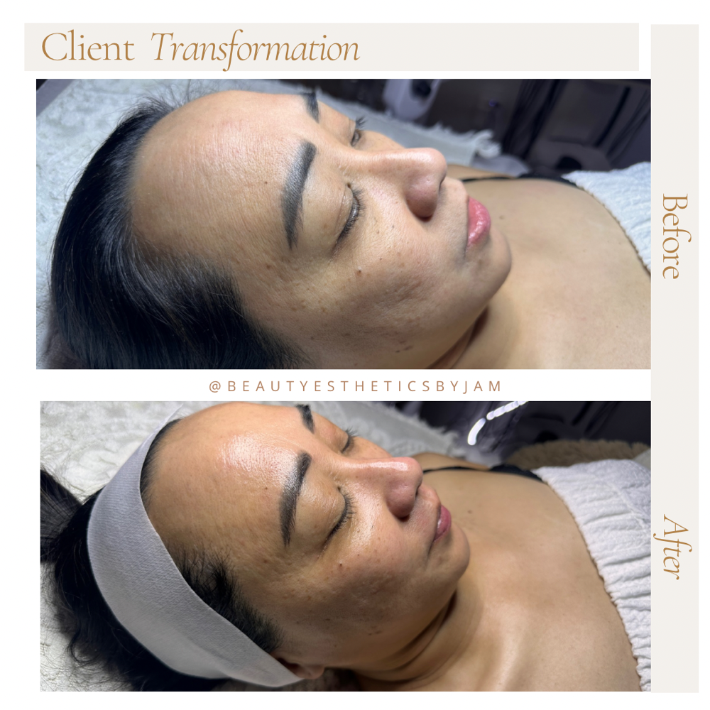 Infusion Facial w/ Dermplaning