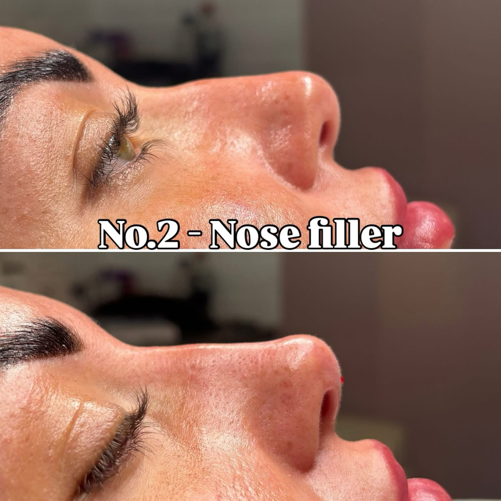 Nose Filler at Lc Beauty Vault in Sinton, TX