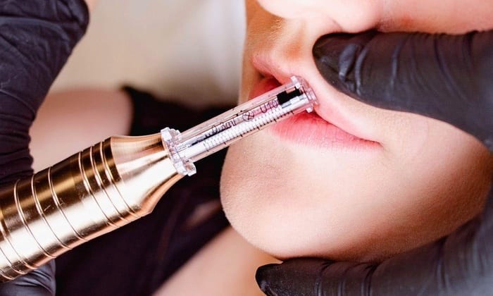 Lip Filler (Needle-Less)
