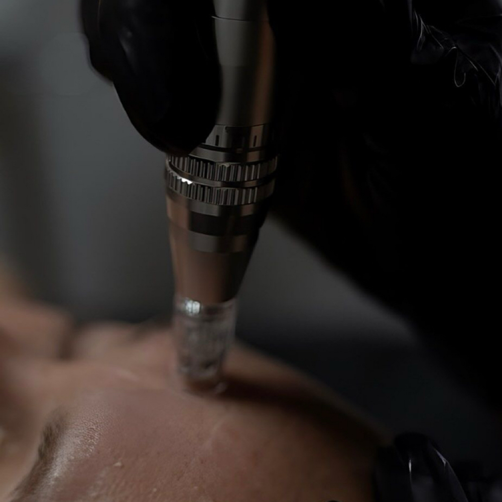 Microneedling at Rooted Glow Esthetics LLC in Colorado Springs, CO