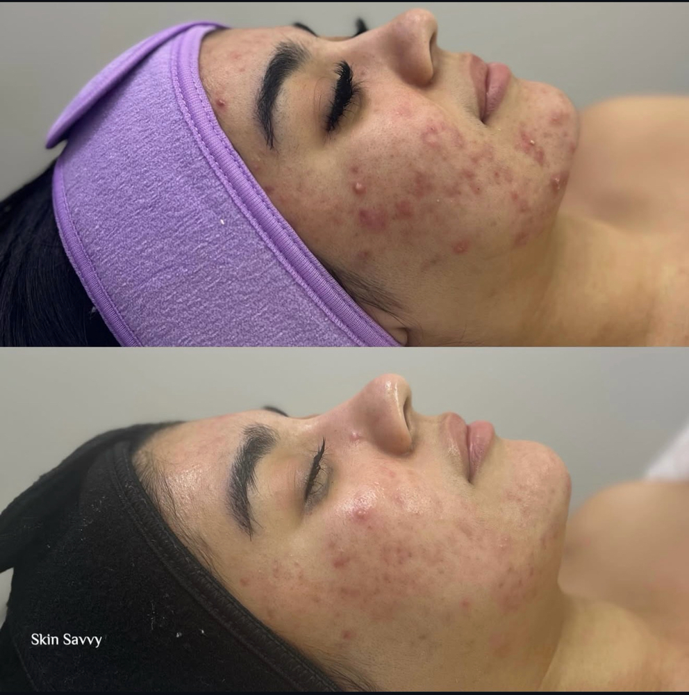 Face Reality Acne Treatment at Skin Savvy SATX in San Antonio, TX