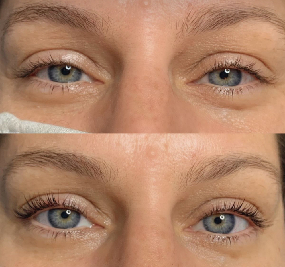 Under-Eye Smooth (Jelly Roll Botox)