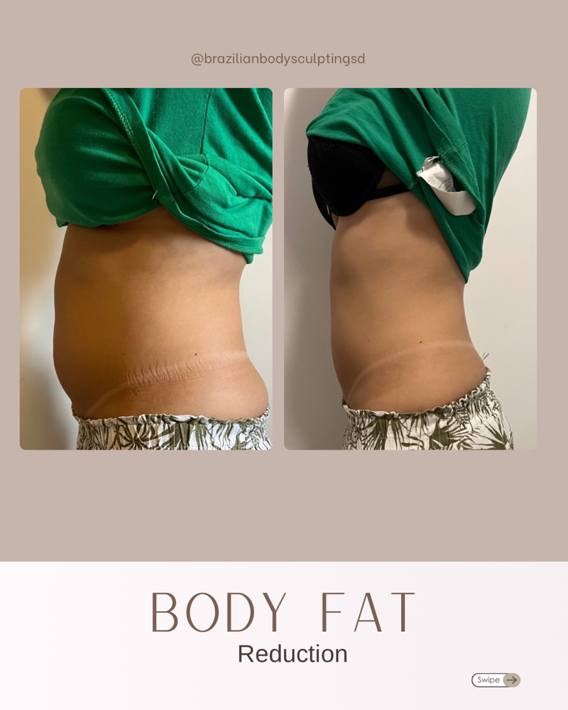 BODY FAT REDUCTION - 4 SESSIONS
