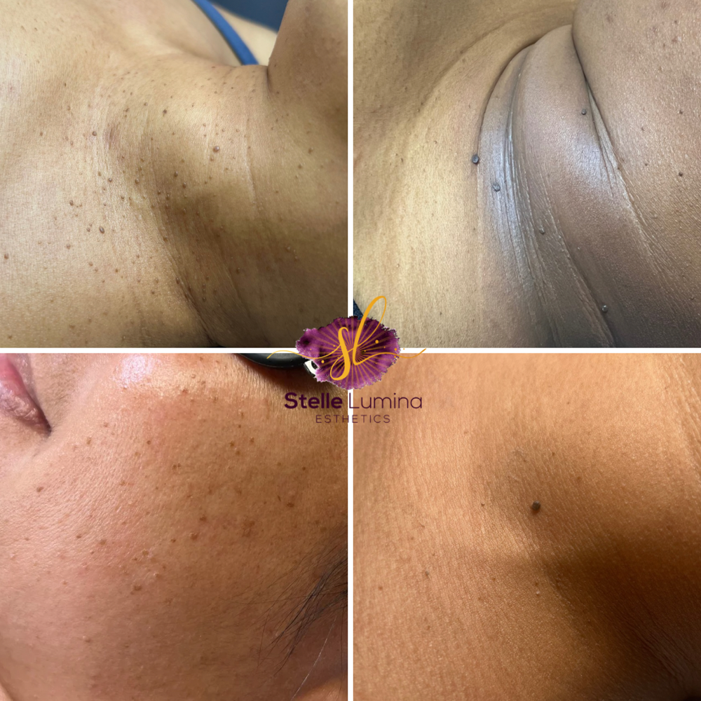 Skin Tag Removal/Milia Removal