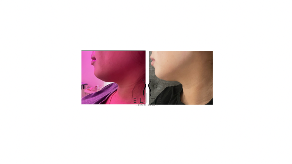 Chin Lipo Laser 2 Sessions